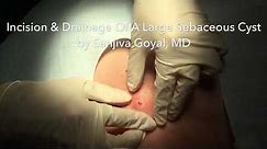 Incision & Drainage of a Large Sebaceous Cyst