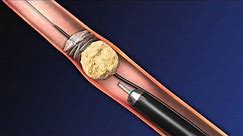 CoAx 10mm Stone Control Catheter from Accordion Medical