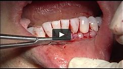 C1-2 AlloDerm Grafting: Class III Recession with Cervical Notching