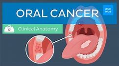 Oral cancer: Epidemiology, risk factors, prevention, symptoms and treatment | Kenhub