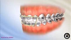 Kako fiksna proteza ispravlja zube ? Snaga i magija ortodoncije 💟