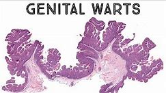 Genital warts under microscope (condyloma acuminatum HPV pathology dermpath dermatology)