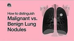 Distinguish Malignant vs. Benign Lung Nodules