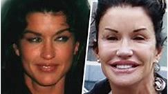 13 celebrità prima e dopo la chirurgia plastica