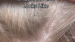 What Head Lice Looks Like 😳 #explore #piojos #headlice #liceinfestation #licetok #liceremoval #hair