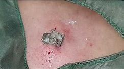 Excision of Sebaceous Cyst from back