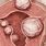 10 Cm Fibroid in Uterus