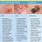4 Types of Skin Cancer