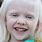 Albinism Symptoms