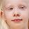 Albinismo Oculocutáneo