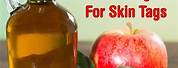 Apple Cider Vinegar Skin Tags