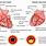 Areas of Myocardial Infarction