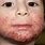 Atopic Dermatitis Eczema On Face