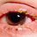 Bacterial Eye Infection