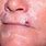 Basal Cell Carcinoma Lesions