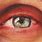 Blepharitis Red Eye