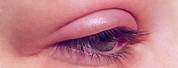 Blepharitis Upper Eyelid