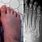 Broken Foot Metatarsal Fracture