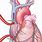 Cardiopulmonary Bypass Cannulation