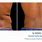 CoolSculpting Flanks Before and After