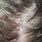 Dermatitis in Hair