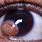 Dermoid Cyst On Eye