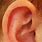 Ear Cartilage Infection