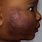 Eczema On Brown Skin