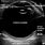 EyeBall Ultrasound