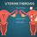 Fibroid Cysts Uterus
