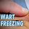 Freezing a Wart