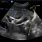 Gallbladder Ultrasound