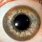 Hemochromatosis Eyes