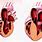 Hipertrofia Cardiaca