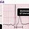 Hypercalcemia On EKG