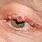 Lesion On Eyelid