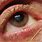 Lower Eyelid Lesion