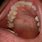 Lump On Roof of Mouth Cancer