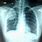 Lung Cancer Ultrasound