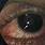Neurosyphilis Eye