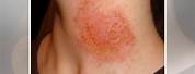 Nickel Allergy Skin Rash