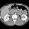 Normal CT Scan Abdomen/Pelvis