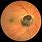 Optic Disc Melanocytoma
