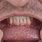 Oral Cancer Lip