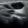 Parotid Cyst Ultrasound
