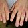 Psoriasis Fingers