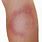 Red Circular Rash On Leg