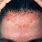 Scabies On Head
