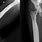 Sclerosing Osteomyelitis
