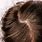 Seborrhea Hair